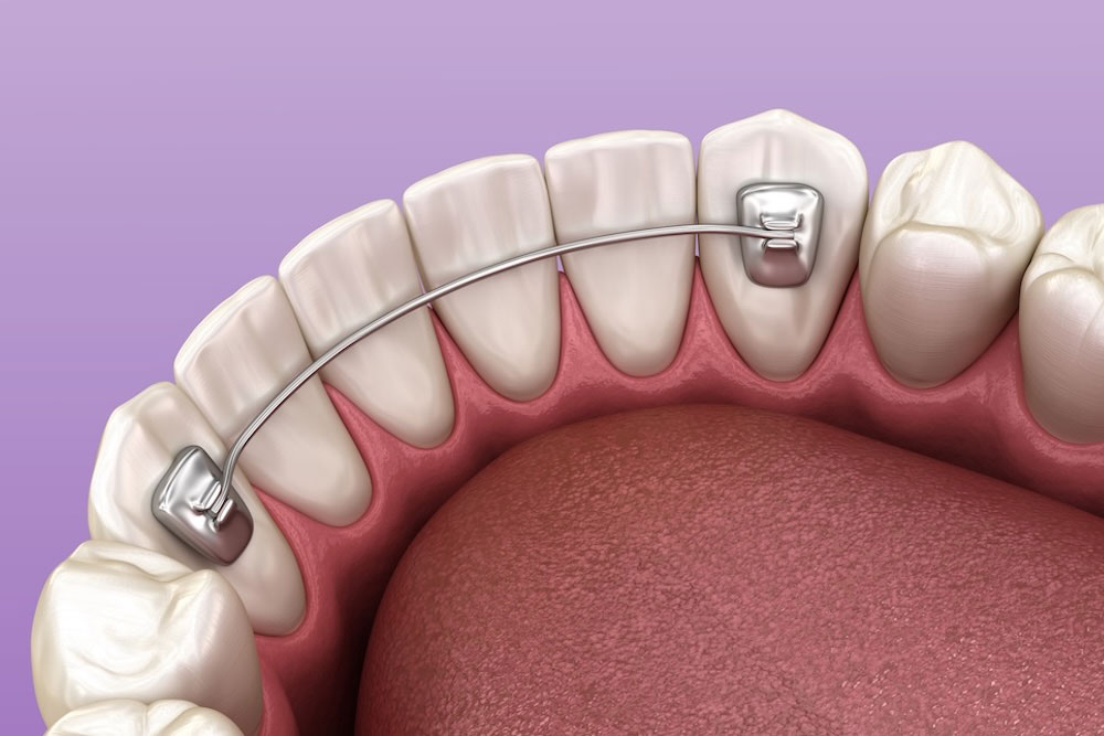 bonded retainers smile isle orthodontics