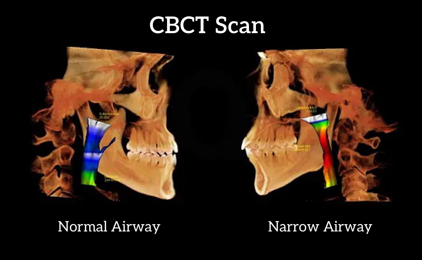 normal and narrow airway scan smile isle orthodontics in odessa FL