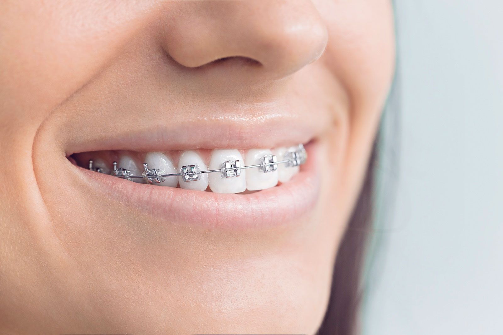 understand the cost of braces in odessa florida at smile isle orthodontics